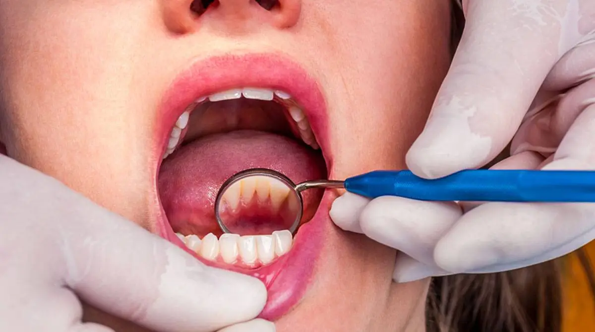 CURETAJE-DENTAL-COMO-SE-HACE