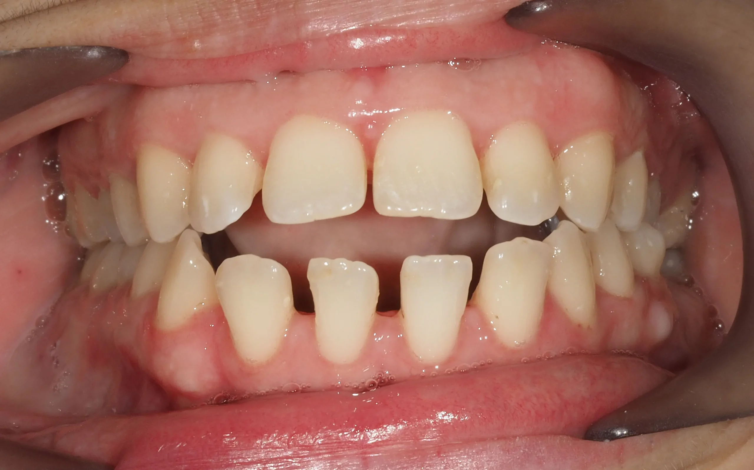 ESPACIOS-ENTRE-DIENTES