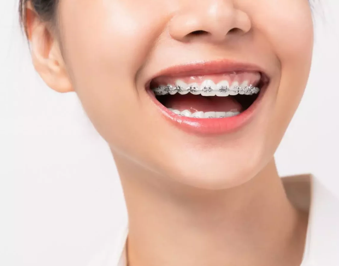 brackets-metalicos