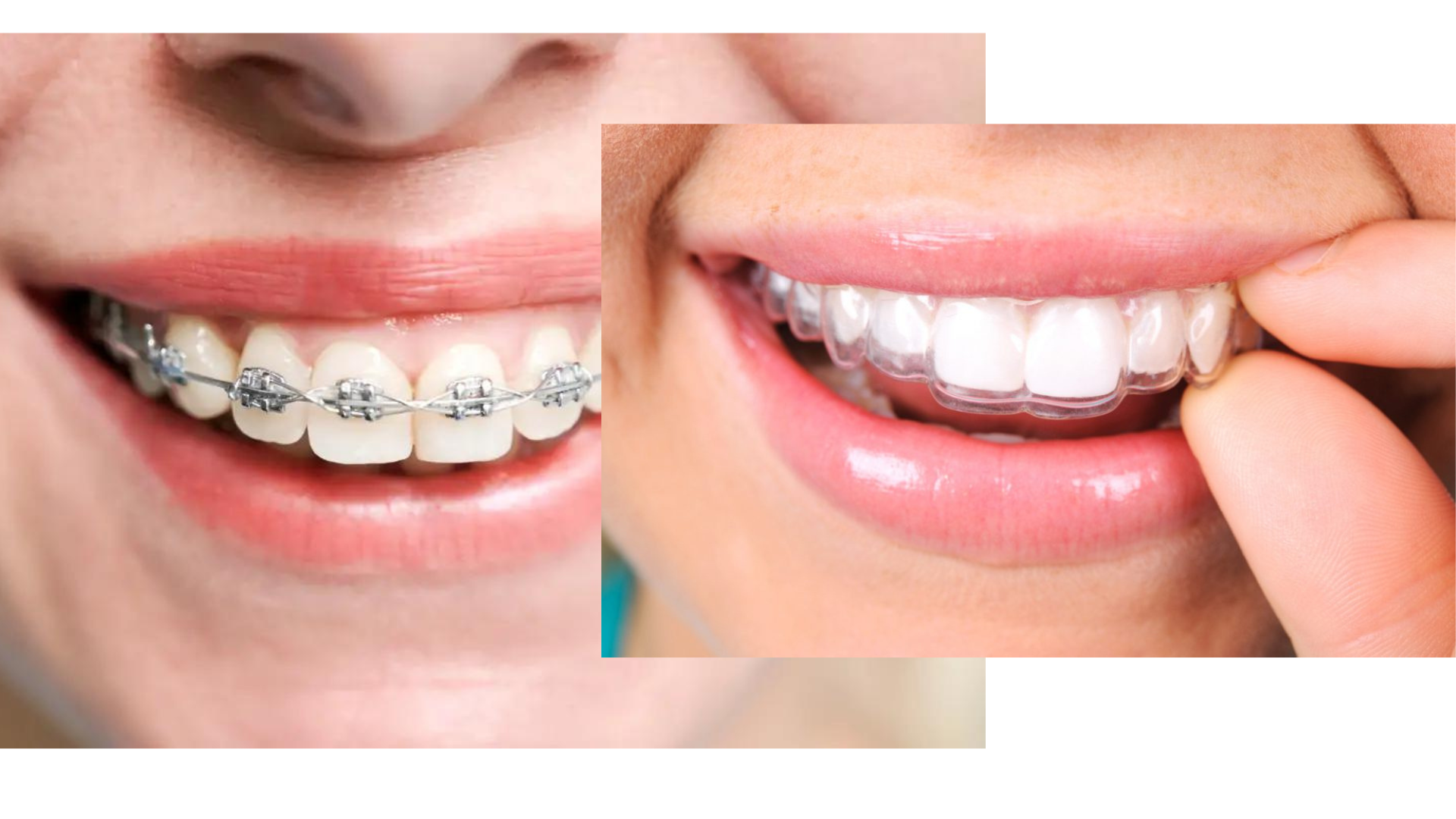 brackets-vs-invisalign