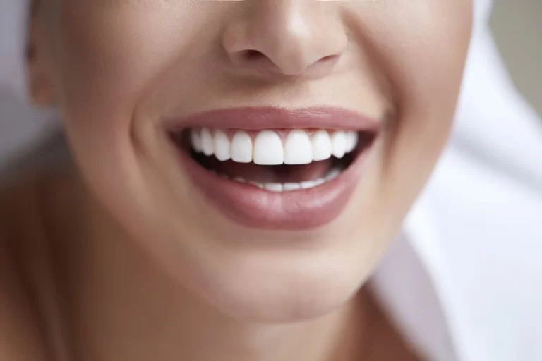 Carillas dentales de Composite. Todo lo que necesitas saber