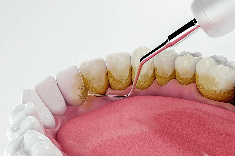 curetaje dental