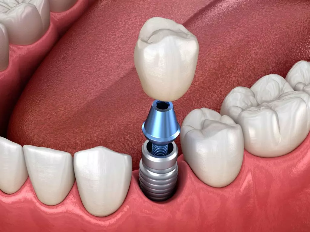 implante-dental-unitario-sevilla