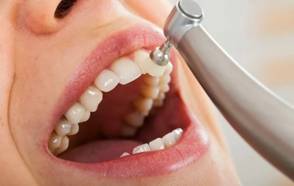 limpieza-dental-profesional