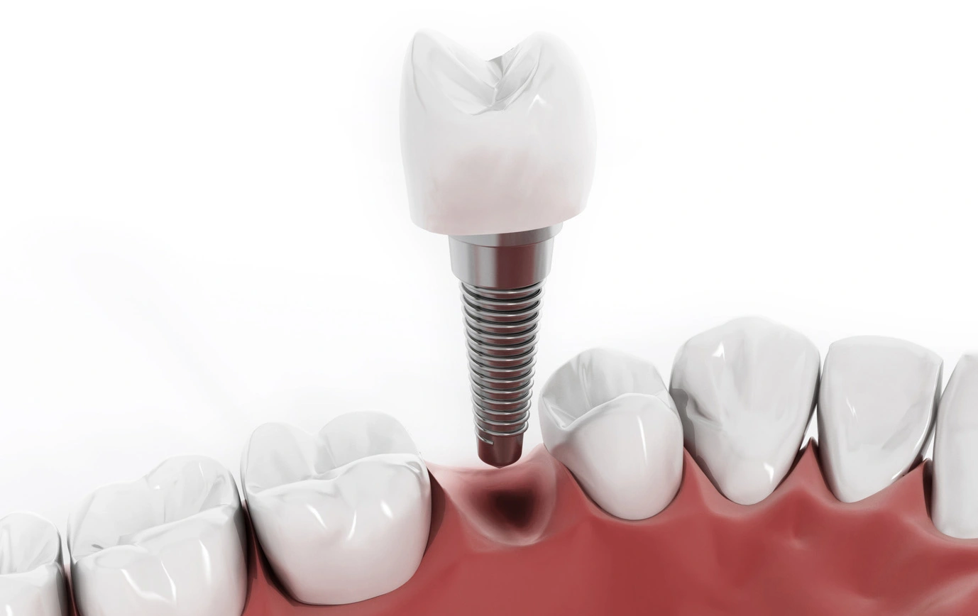 ortodoncias_brackets