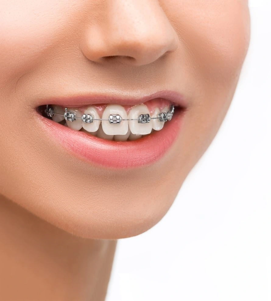 ortodoncias_brackets
