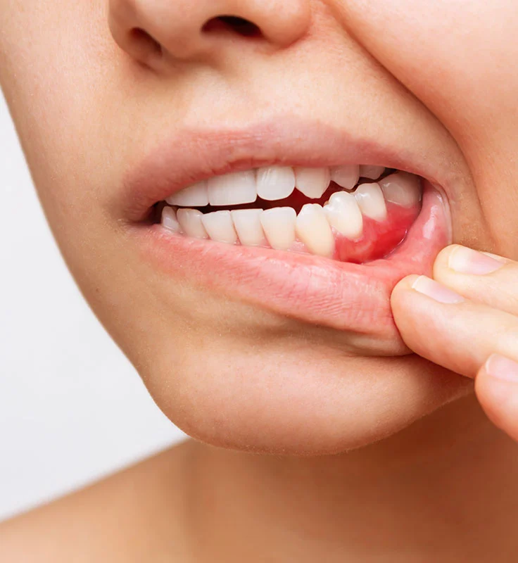 popup-periodoncia