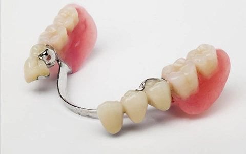 protesis-dental-esqueletica