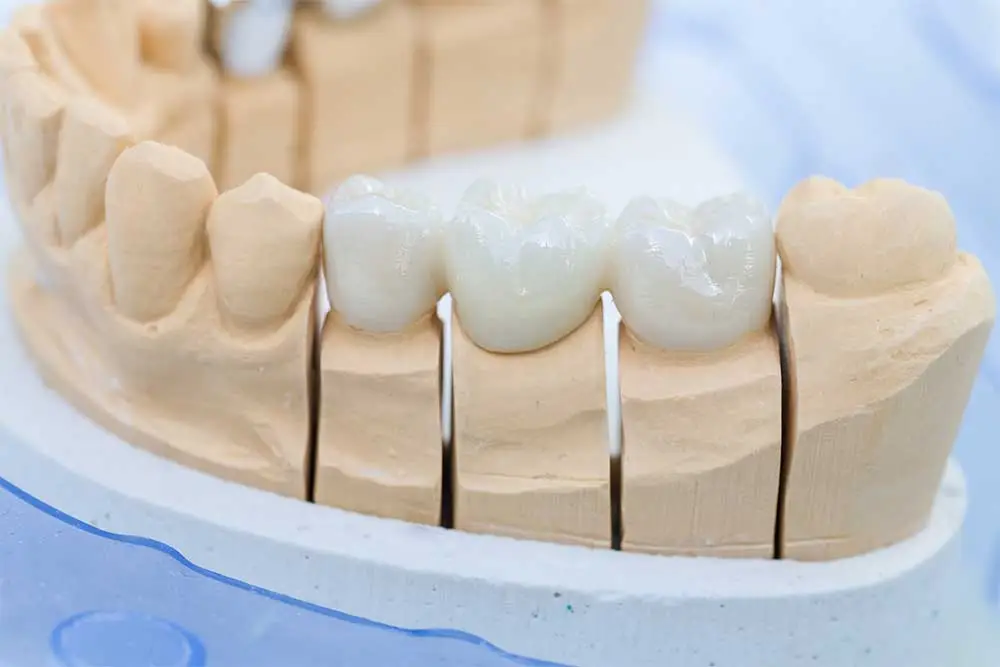puente-denta-porcelana