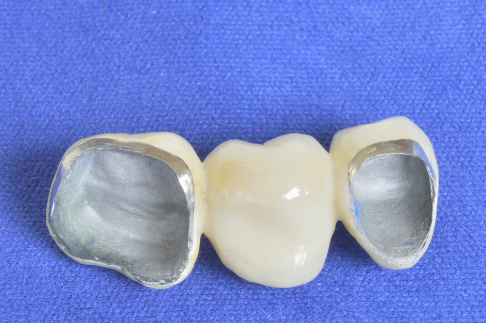 puente-dental-metal-porcelana