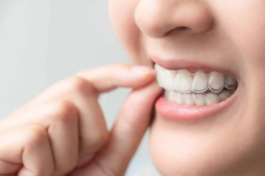 riesgos-no-usar-retenedores-dentales
