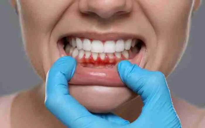 Sangrado dental
